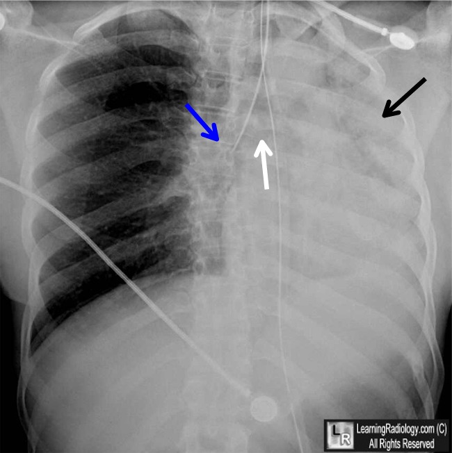 Endotracheal Tube (ETT) too low